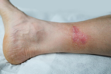 large healing wound from a severe burn on the leg of an adult male patient, redness, scarring of...