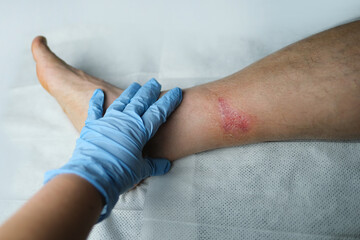 doctor treats a large healing wound from a severe burn on the leg of an adult male patient,...