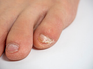 close-up of toes with nail problems. Infection, cracks, improper care. Nail care concept