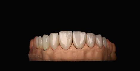 dental ceramic crowns, laminate veneers. 3d printed dental model