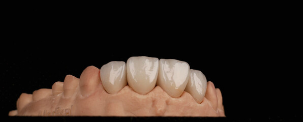dental ceramic crowns, laminate veneers. 3d printed dental model