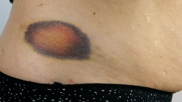 Hands of senior woman examines purple big bruise or haematoma and touches with fingers. Subcutaneous trauma from domestic violence or injury. Close-up.