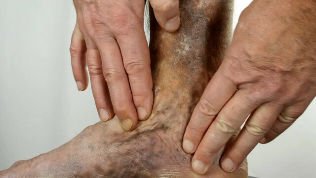 Human hands touch and crumple sore spotty leg of person suffering from blockage of veins, ulcers, dermatitis, eczema or other infectious diseases of dermatology. Close-up.