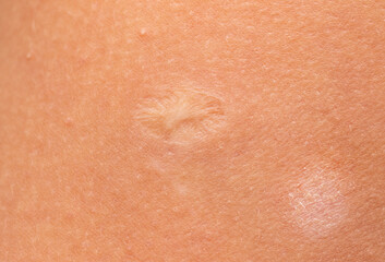 vaccination scar on the skin of the hand