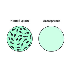 semen analysis, normal sperm and azoospermia. male reproductive system concept. Flat illustration.
