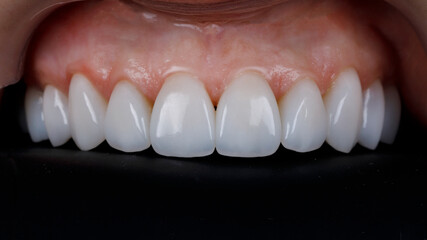 upper jaw veneers in the patient's mouth