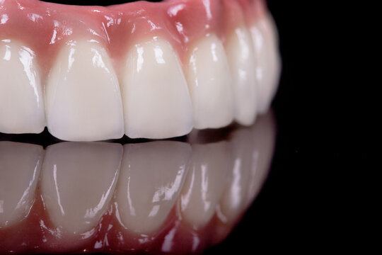 Beautiful upper teeth ceramic press ceramic crowns and veneers on the dental stone model zircon arch ceramic prothesis Implants . Dental restoration treatment clinic patient. oral surgery dentist