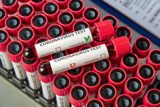 Blood test tubes for COVID-19 on vacuum tubes with blood samples. Blood test for the presence of antibodies to the causative agent of a new coronavirus infection.