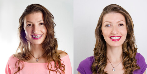 Closeup shot of young woman before and after dental braces, two years apart 