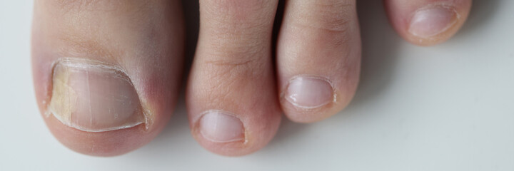 Yellow spot mycosis on big toe nail closeup. Treatment of nail diseases concept.