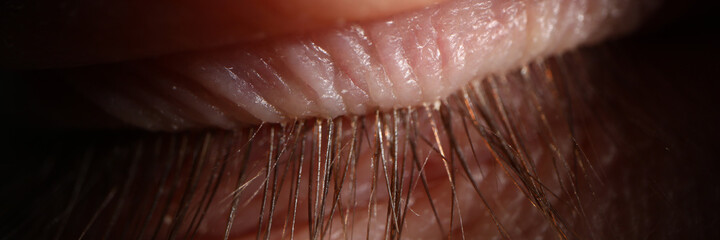 Close up of sleeping person with long eyelashes and eyelid disease