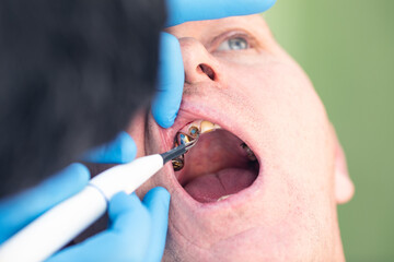 The dentist treats the patient's teeth. Dentistry. Dental care. A man treats his teeth at the...