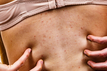 Naklejka premium Woman with skin problem acne on back