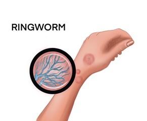 Illustration of the ringworm on the hand