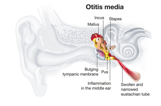 Inflammation Of The Middle Ear, Otitis Media, Medically Illustration