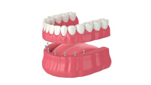 Removable snap-on full implant denture installation