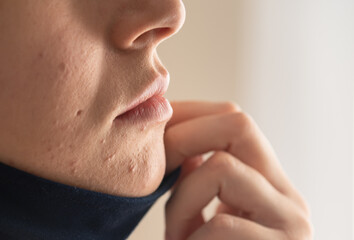 Woman with acne and irritation from wearing a mask.