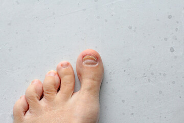 Exfoliation of nail on big toe, close-up in woman, girl. Toenail damage, fungus, trauma, big toe nail problems, nail detachment, on light white modern concrete background. Nail disease treatment
