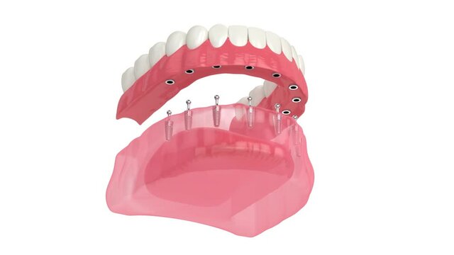 Removable snap-on full implant denture installation