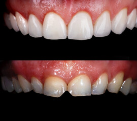 Perfect smile before and after bleaching procedure whitening of zircon arch ceramic prothesis...