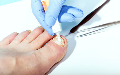 A dermatologist uses an ointment to treat a patient with a lesion of the nail plate on the feet