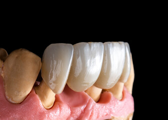 4 units natural look press ceramic bridge