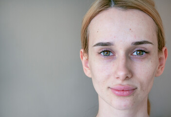 
Young girl with problem skin, age spots and acne