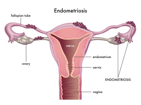 Anatomical illustration of the female reproductive system with the symptoms of endometriosis, with annotations.
