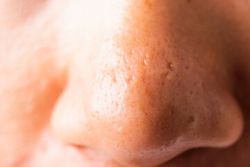 Fototapeta premium Closeup Asian young woman large pores have freckles cheek oily, acne pimple on nose, studio shot isolated on white background, Healthcare beauty skin face problem concept