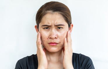 Unhappy Asian woman having problems of acne inflamed on her face. Inflamed acne consists of swelling, redness, and pores that are deeply clogged with bacteria, oil, and dead skin cells.