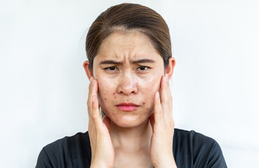 Unhappy Asian woman having problems of acne inflamed on her face. Inflamed acne consists of...