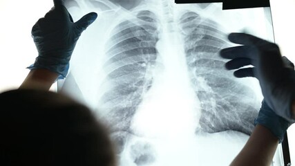 An x-ray of the lungs is discussed by doctors wearing medical gloves. Fluorography of a patient with an initial stage of pneumonia - Powered by Adobe