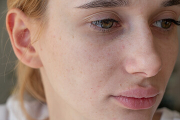 
The girl has blackheads on her cheeks and nose