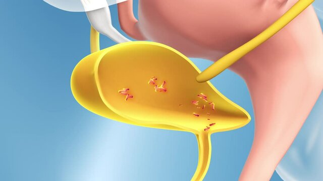 Cystitis, urinary tract infection or inflammation of the bladder. The bacteria multiplies in the bladder causing an infection. 3D animation on white background