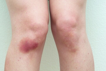 Caucasian young woman's bruised knee close up shot isolated unrecognizable
