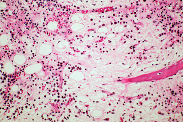 Microscope of Adenoid cystic carcinoma, rare type of cancer exist in many different body sites. This tumor occurs in the salivary glands, with close up macro 40x lens, microbiology laboratory concept.