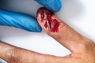 A bloody thumb with a deep cut and blood is visible on a white background