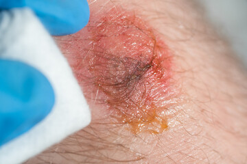 Macro shot of a male knee with abrasion
