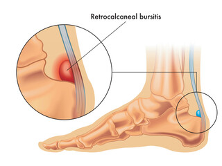 Illustration showing the position of the normal retrocalcaneal bursa in the foot, and in enlarged detail a retrocalcaneal bursitis, annotated on white.
