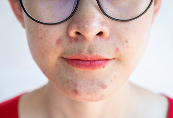 Woman having problems of acne inflamed on her lower face.