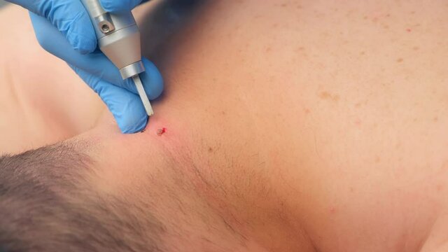 Surgeon removing small moles using laser on man's neck, burning skin, closeup view. One day surgery concept. Removing papillomas or birthmarks, surgical procedure.