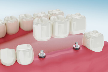 Dental Implants Treatment Procedure. Medically accurate 3D illustration.