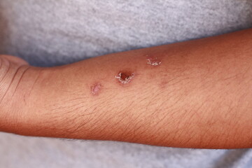 Allergic skin lesions on the arms.