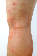 Naklejka premium A close-up of bad psoriasis on a person's leg. Eczema allergy skin, dermatologic diseases. 