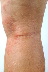 A close-up of bad psoriasis on a person's leg. Eczema allergy skin, dermatologic diseases. 