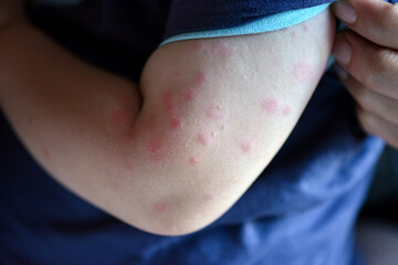 Child with hives on his arm. Hives, also known as urticaria, is a kind of skin rash with red,...