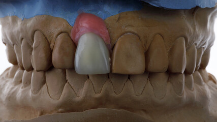 Fototapeta premium composition of the dental model and the ceramic crown of the central incisor made of high-quality ceramic