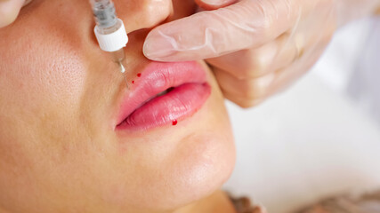 Beautician in transparent sterile gloves performs lips augmentation operation with special syringe under bright electric light extreme closeup