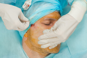 A man doing mesothreads and Thread Lifting, Cosmetic procedure to eliminate signs of aging. 