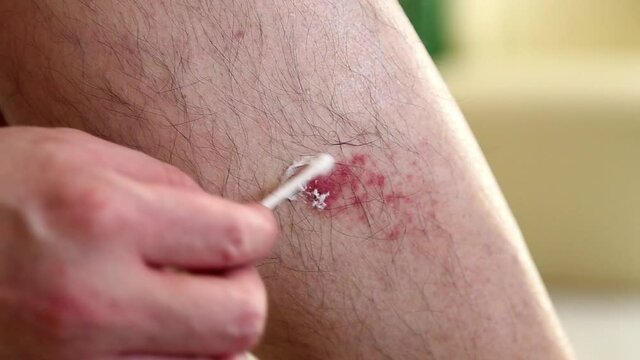 Man pasting an ointment on wound place